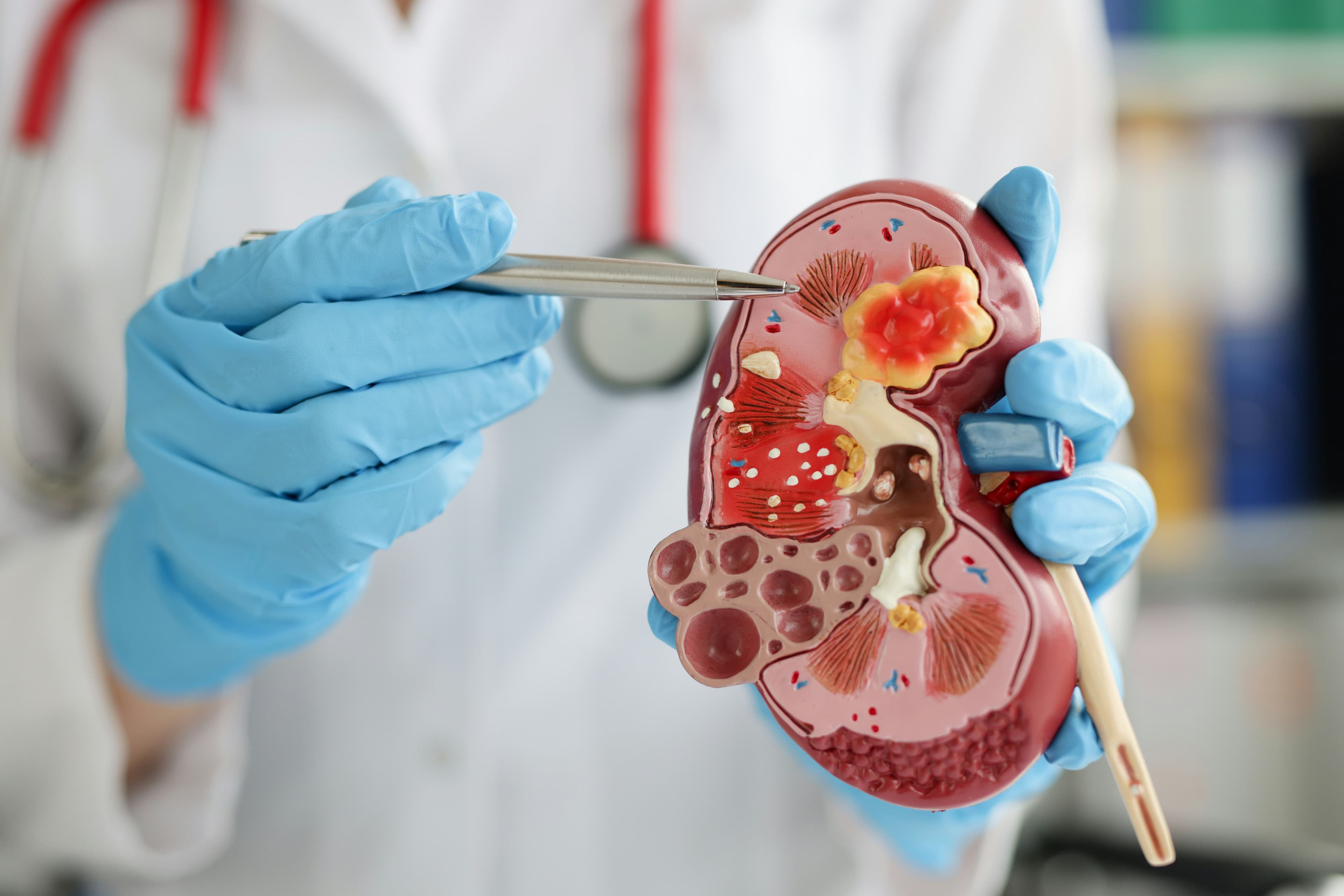 Kidney stones during pregnancy: A clinical case.